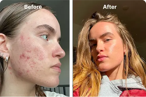 A person looking frustrated with their skin